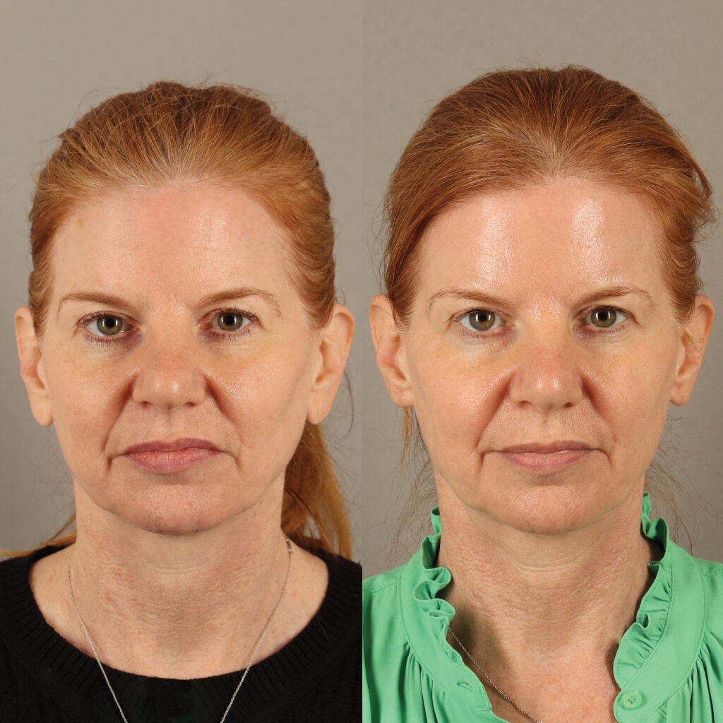 103 - AO - Earlobe Reduction - Full Face_3