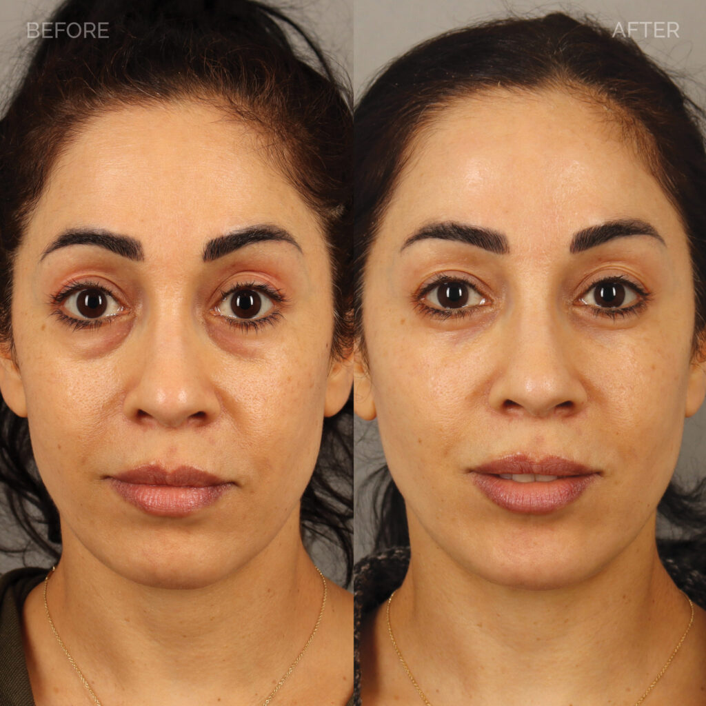 95-DO-Undereye-and-Cheek-Filler-No-Restrictions_2-scaled