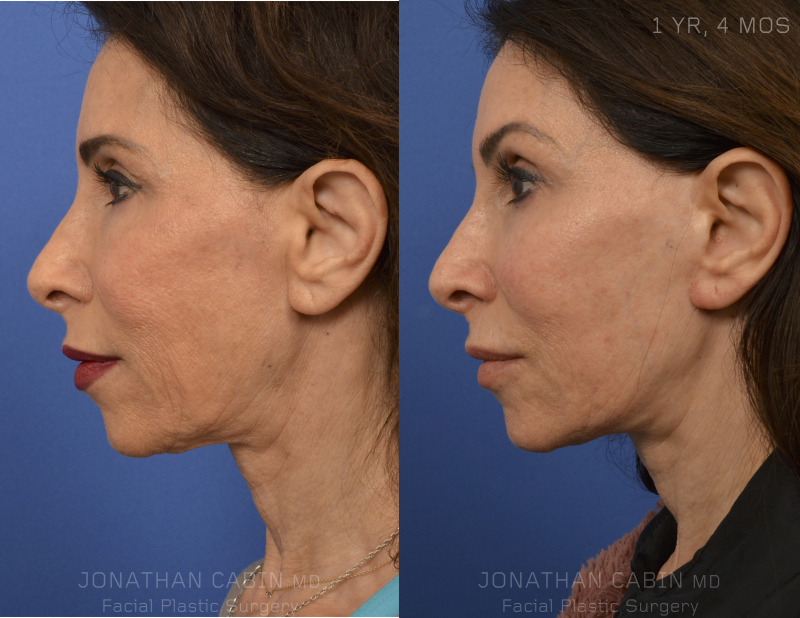 year-4-Months-Facelift-Side-L-BEST.jpg